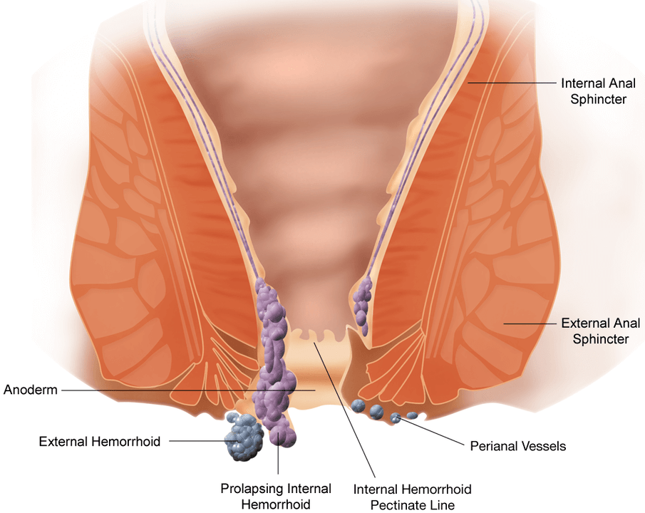 The development of hemorrhoids is accompanied by pain, itching and loss of the lymph nodes